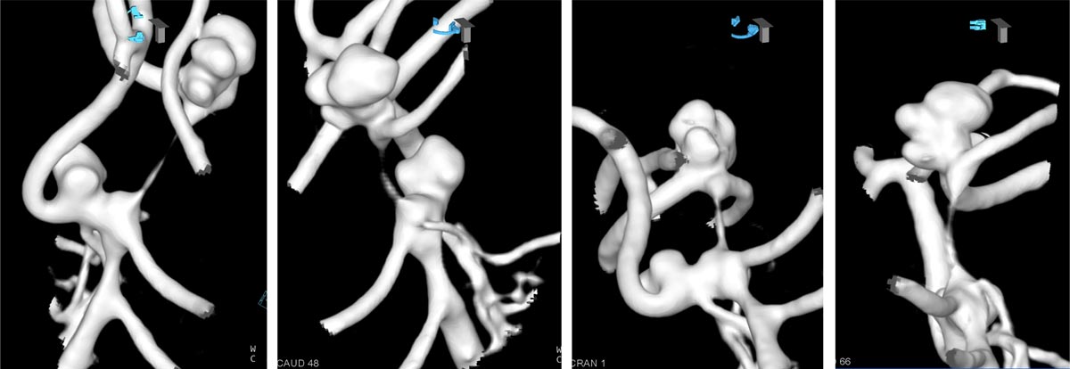 Are wide-neck and highly irregularly shaped MCA ruptured aneurysms always a good indication for surgery - Figure 3