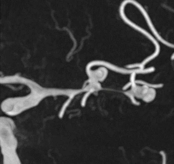Are wide-neck and highly irregularly shaped MCA ruptured aneurysms always a good indication for surgery - Figure 4