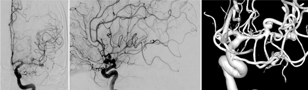 Are wide-neck and highly irregularly shaped MCA ruptured aneurysms always a good indication for surgery - Figure 5