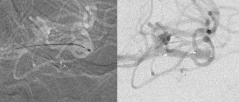 Are wide-neck and highly irregularly shaped MCA ruptured aneurysms always a good indication for surgery - Figure 7