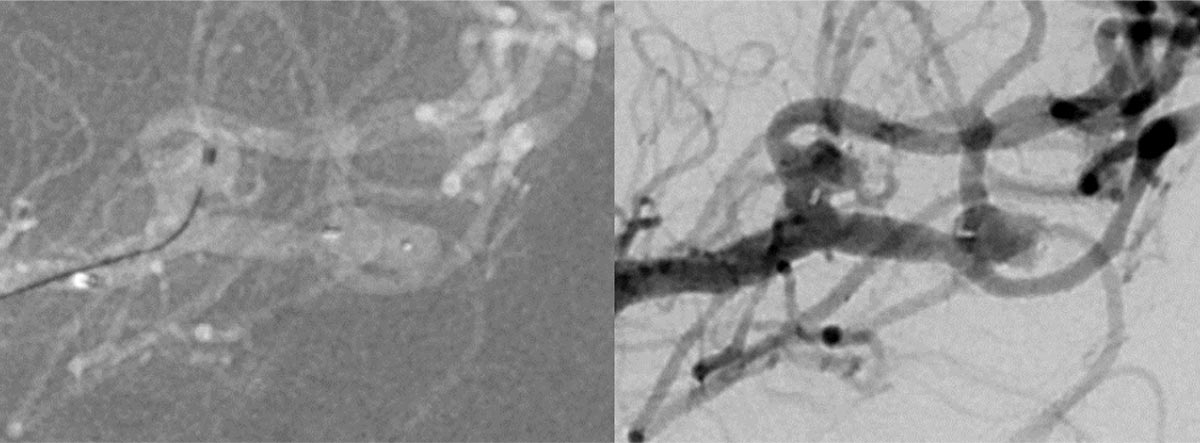 Are wide-neck and highly irregularly shaped MCA ruptured aneurysms always a good indication for surgery - Figure 8