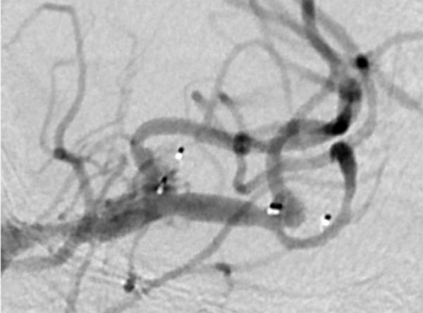 Are wide-neck and highly irregularly shaped MCA ruptured aneurysms always a good indication for surgery - Figure 9