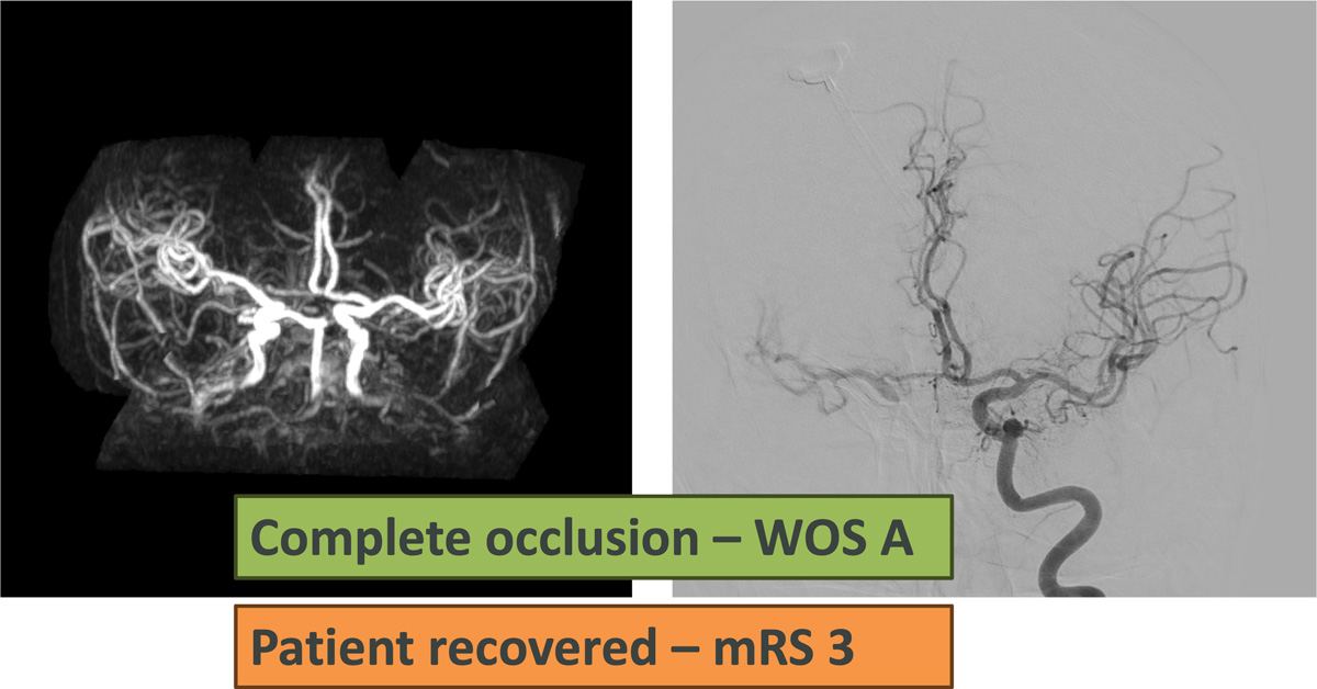 Quick Control – WEB for the Acute Treatment of a Ruptured, Irregular ACoA Aneurysm - Figure 10