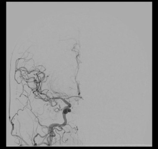Quick Control – WEB for the Acute Treatment of a Ruptured, Irregular ACoA Aneurysm - Figure 2