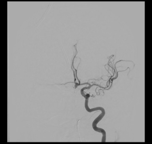 Quick Control – WEB for the Acute Treatment of a Ruptured, Irregular ACoA Aneurysm - Figure 3