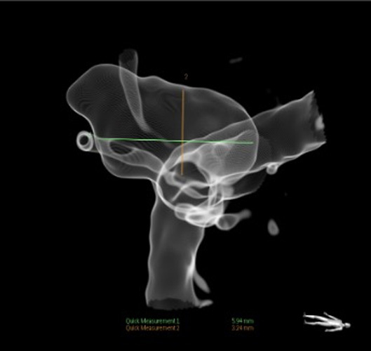 Quick Control – WEB for the Acute Treatment of a Ruptured, Irregular ACoA Aneurysm - Figure 4