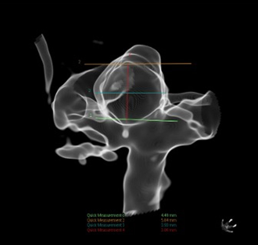 Quick Control – WEB for the Acute Treatment of a Ruptured, Irregular ACoA Aneurysm - Figure 5