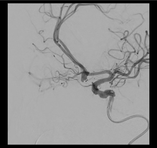 Quick Control – WEB for the Acute Treatment of a Ruptured, Irregular ACoA Aneurysm - Figure 7