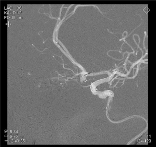 Quick Control – WEB for the Acute Treatment of a Ruptured, Irregular ACoA Aneurysm - Figure 8