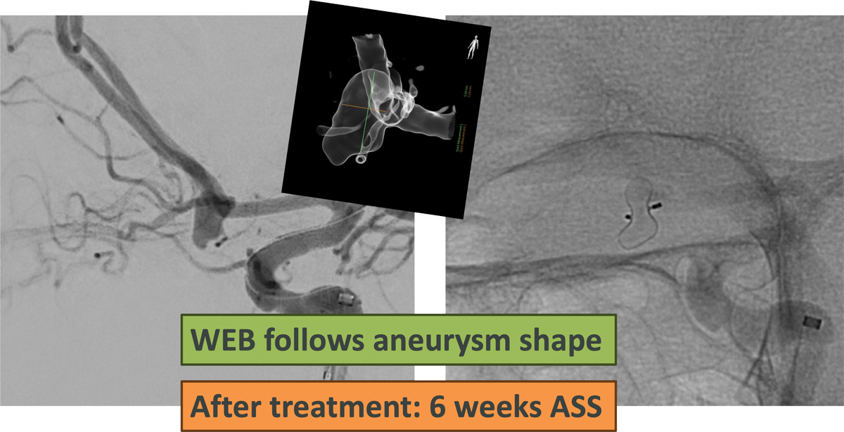 Quick Control – WEB for the Acute Treatment of a Ruptured, Irregular ACoA Aneurysm - Figure 9
