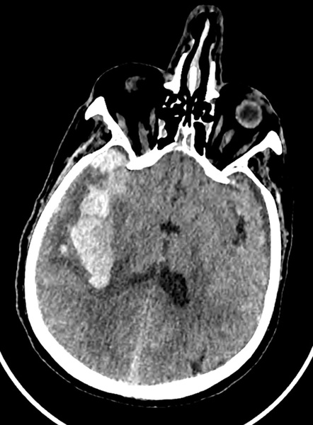 ruptured-aneurysm-treated-by-web-figure1