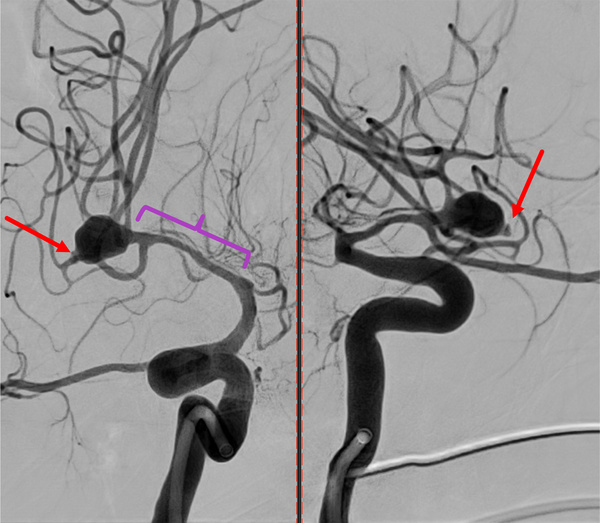 ruptured-aneurysm-treated-by-web-figure2