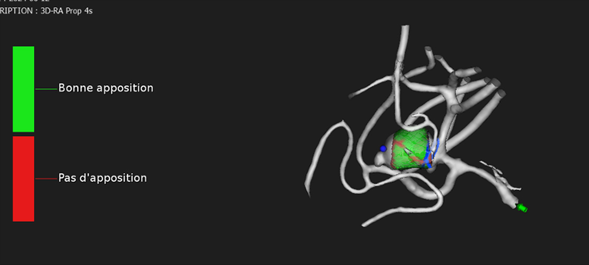 ruptured-aneurysm-treated-by-web-figure3