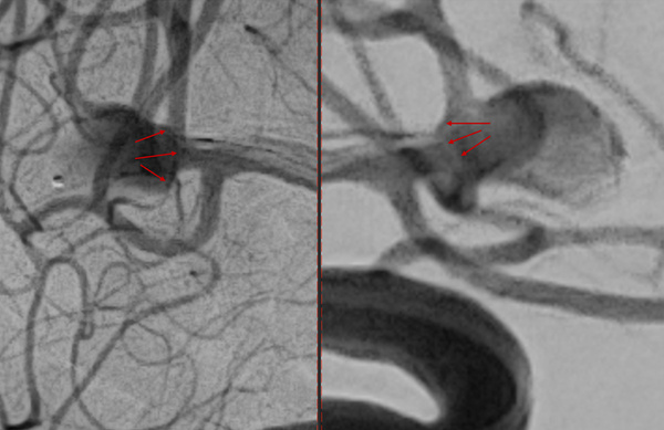 ruptured-aneurysm-treated-by-web-figure4