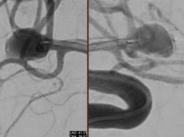 ruptured-aneurysm-treated-by-web-figure5