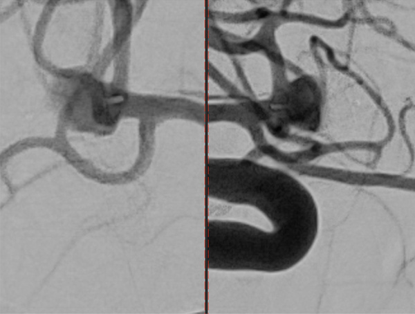 ruptured-aneurysm-treated-by-web-figure6