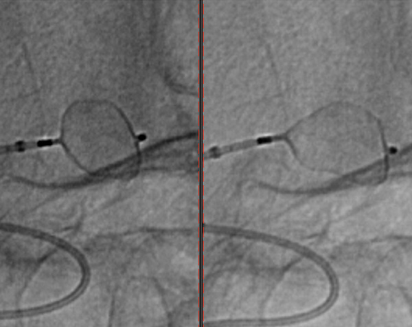 ruptured-aneurysm-treated-by-web-figure7