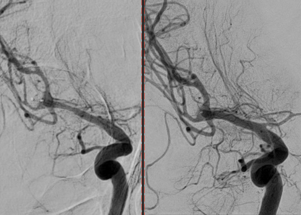ruptured-aneurysm-treated-by-web-figure8
