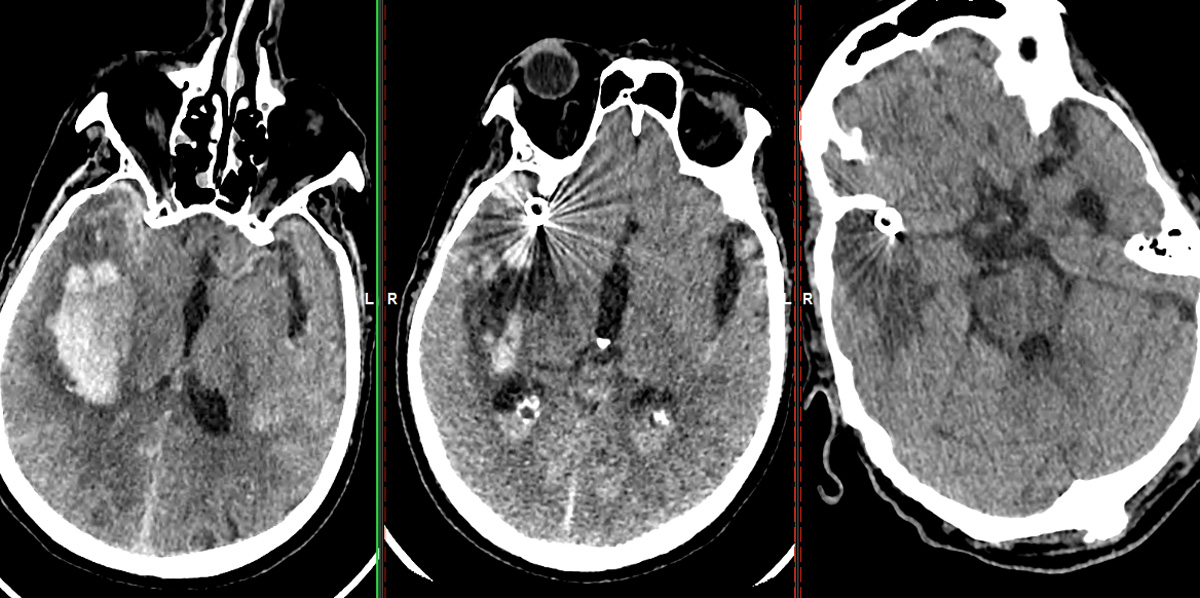 ruptured-aneurysm-treated-by-web-figure9