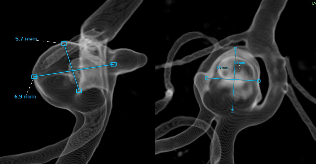 threading-the-needle-figure3