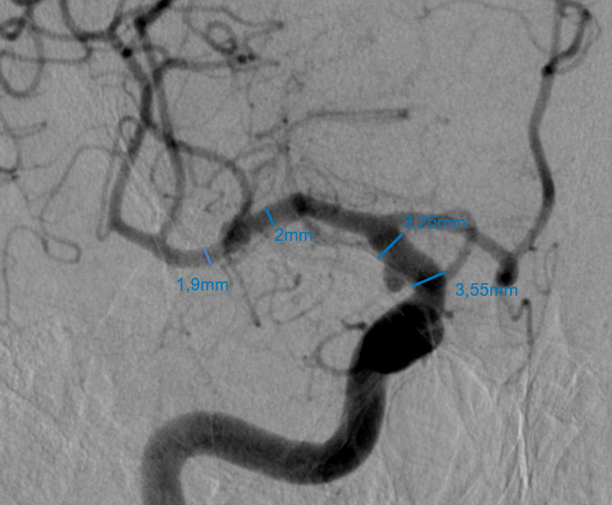 10-acute-fds-twisting-and-its-management-dsa-measurements