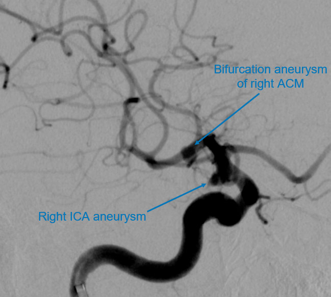 11-acute-fds-twisting-and-its-management-dsa-oblique-projection