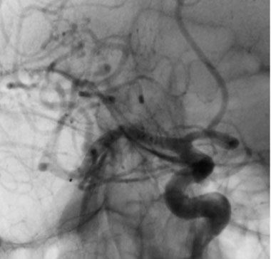 12-acute-fds-twisting-and-its-management-right-mca-aneurysm-treatment-1