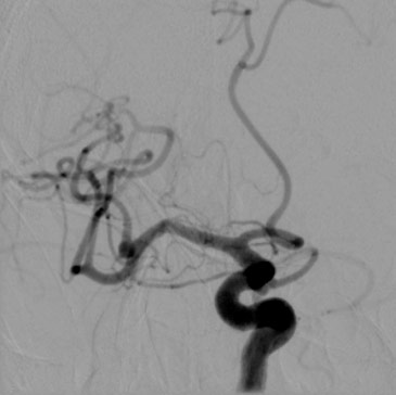 13-acute-fds-twisting-and-its-management-right-mca-aneurysm-treatment-2