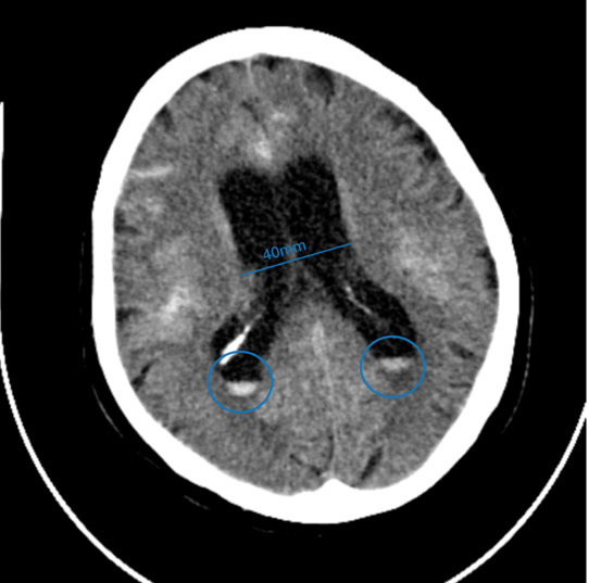 22-acute-fds-twisting-and-its-management-follow-up-ct-mild-progression-of-sah