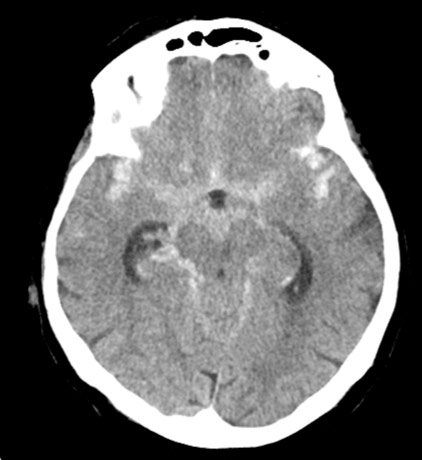 4-acute-fds-twisting-and-its-management-ct-finding-2