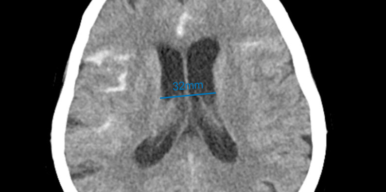 5-acute-fds-twisting-and-its-management-ct-finding-3