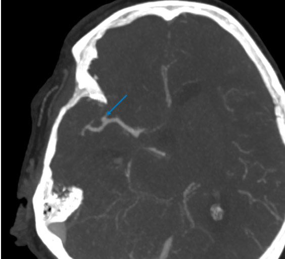 7-acute-fds-twisting-and-its-management-ct-angio-1
