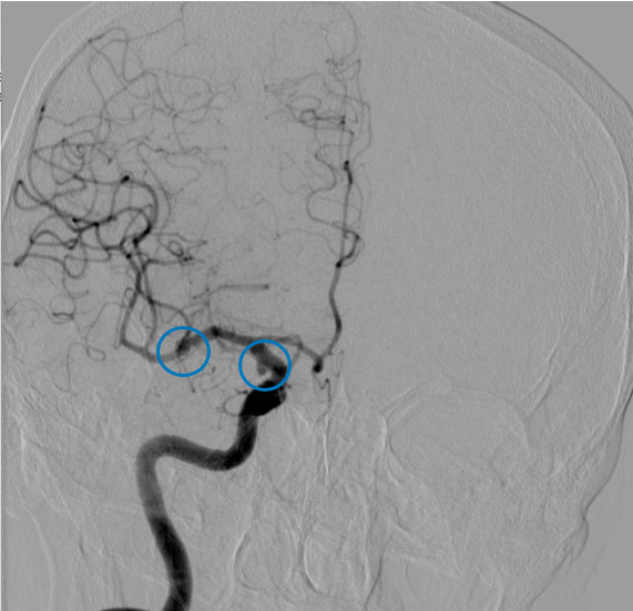 9-acute-fds-twisting-and-its-management-indication-for-dsa