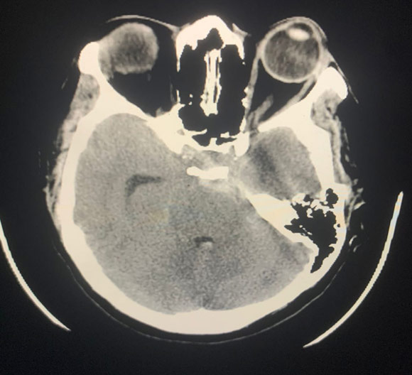 image1-acute-treatment-of-ruptured-fusiform-basilar-aneurysm-case-presentation-1