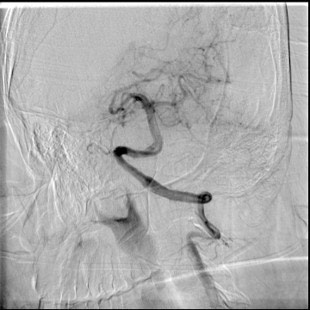 image10-acute-treatment-of-ruptured-fusiform-basilar-aneurysm-3y-controls-mrs-4