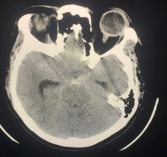 image2-acute-treatment-of-ruptured-fusiform-basilar-aneurysm-case-presentation-2