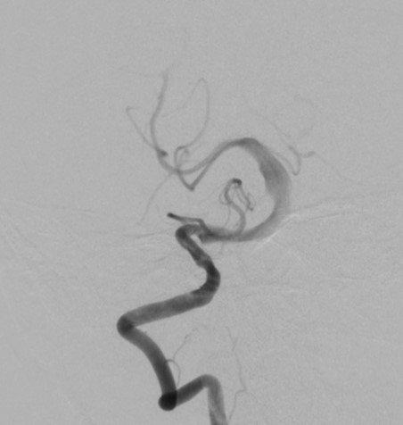 image3-acute-treatment-of-ruptured-fusiform-basilar-aneurysm-diagnostic-angio-1