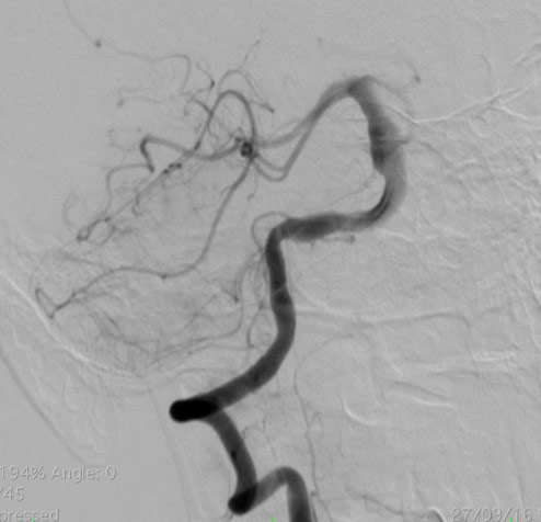 image4-acute-treatment-of-ruptured-fusiform-basilar-aneurysm-diagnostic-angio-2