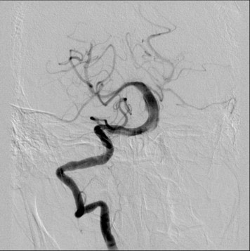 image6-acute-treatment-of-ruptured-fusiform-basilar-aneurysm-pipeline-flex-flow-divert