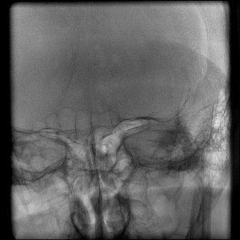 image7-acute-treatment-of-ruptured-fusiform-basilar-aneurysm-3y-controls-mrs-1