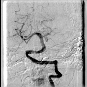 image8-acute-treatment-of-ruptured-fusiform-basilar-aneurysm-3y-controls-mrs-2