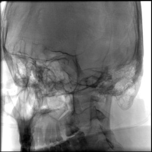 image9-acute-treatment-of-ruptured-fusiform-basilar-aneurysm-3y-controls-mrs-3