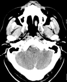 image1-acute-treatment-of-ruptured-fusiform-v4-aneurysm-case-presentation-1