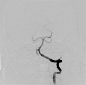 image10-acute-treatment-of-ruptured-fusiform-v4-aneurysm-pipeline-flex-flow-divert-3