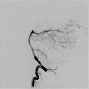 image11-acute-treatment-of-ruptured-fusiform-v4-aneurysm-pipeline-flex-flow-divert-4