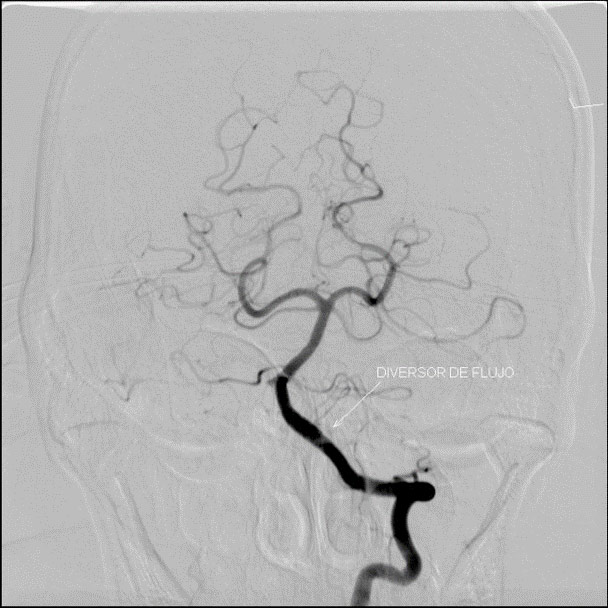 image12-acute-treatment-of-ruptured-fusiform-v4-aneurysm-1y-control-mrs0-1