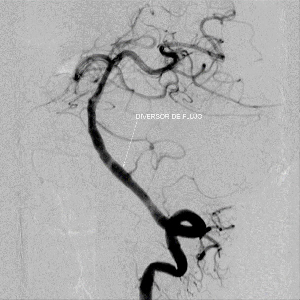 image13-acute-treatment-of-ruptured-fusiform-v4-aneurysm-1y-control-mrs0-2