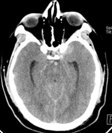 image2-acute-treatment-of-ruptured-fusiform-v4-aneurysm-case-presentation-2