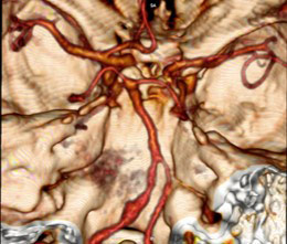 image3-acute-treatment-of-ruptured-fusiform-v4-aneurysm-case-presentation-3
