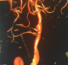 image4-acute-treatment-of-ruptured-fusiform-v4-aneurysm-case-presentation-4